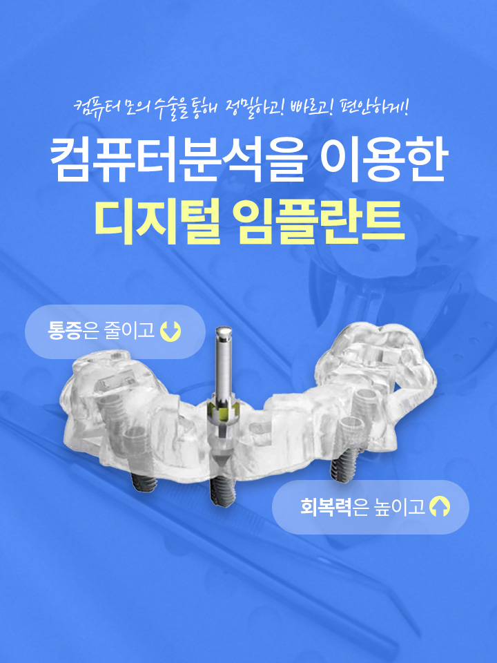 컴퓨터분석을 이용한 디지털 임플란트